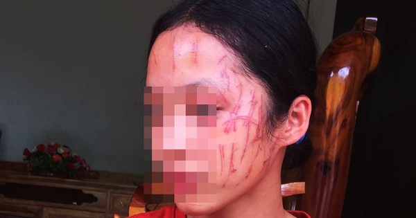Mới tí tuổi đã cào nát mặt nhau: Các con chúng ta đang làm gì vậy?