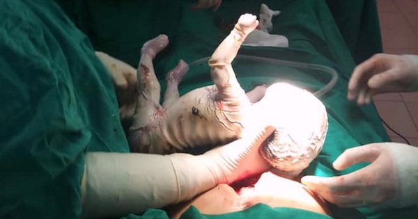 Cô gái 15 tuổi sinh con toàn thân bọc vảy trắng, da nứt nẻ, chảy máu