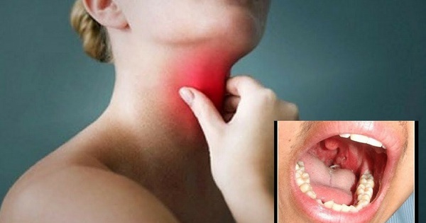 Bệnh nhân lo sợ ung thư khi đau âm ỉ vùng dưới xương ức, bác sĩ tìm ra nguyên nhân là… chiếc xương cá