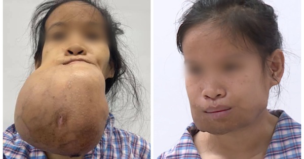 “Khổ sở” với khối u khủng, suốt nhiều năm cô gái trẻ phải dùng khăn che kín mặt
