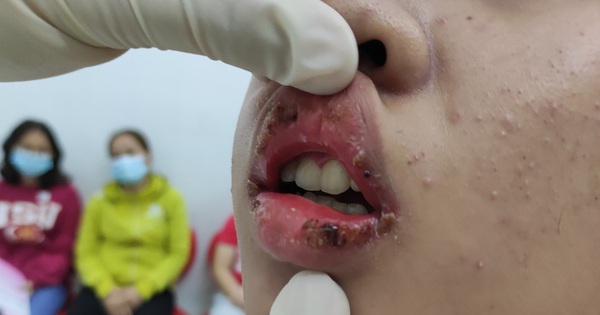 Thiếu nữ 15 tuổi bị lở loét môi vì sử dụng son mua trên mạng