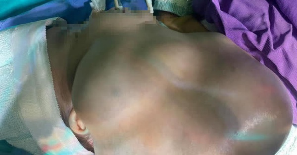 Giải phóng khối u “khủng” choán toàn bộ nửa mặt bé trai 1 tháng tuổi ở Hà Giang