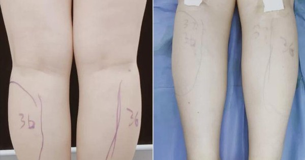 Ham có đôi chân nuột nà, thon gọn, cô gái quyết định đến cơ sở thẩm mỹ để cắt dây thần kinh - Vimarsana News