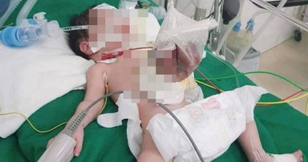 Nghệ An: Cứu sống bé sơ sinh có nội tạng nằm ngoài ổ bụng