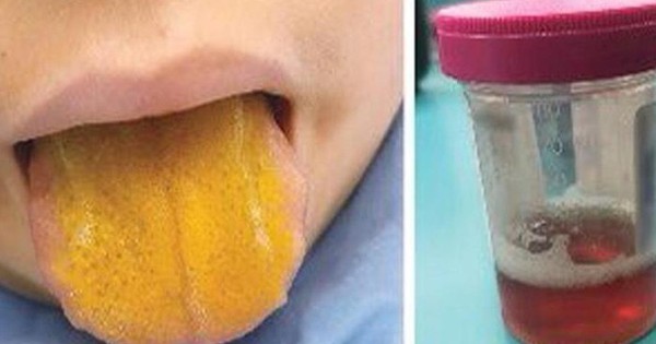 Bác sĩ cũng sốc khi thấy lưỡi cậu bé 12 tuổi chuyển thành màu vàng, nước tiểu sẫm màu - Vimarsana News
