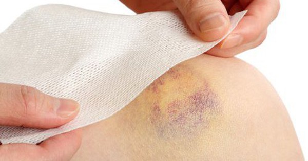 Có cách nào để điều trị chân bị bầm không rõ nguyên nhân?
