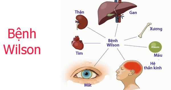 Ai nên được kiểm tra và chẩn đoán về bệnh Wilson?
