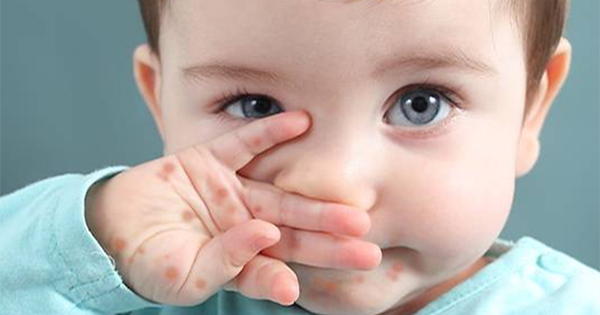 Những mẹo dân gian chữa bệnh chân tay miệng hiệu quả và an toàn cho trẻ em