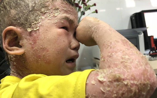 Rớt nước mắt hình ảnh cậu bé toàn thân mọc mụn mủ, lở loét