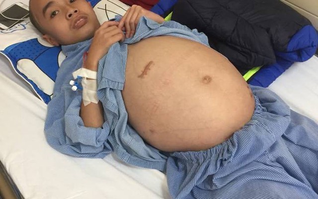 Sự sống mong manh của bé trai 10 tuổi phải phẫu thuật u não 5 lần