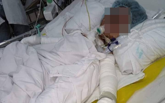 Khốn khổ cả nhà bị bỏng nặng vì rò gas