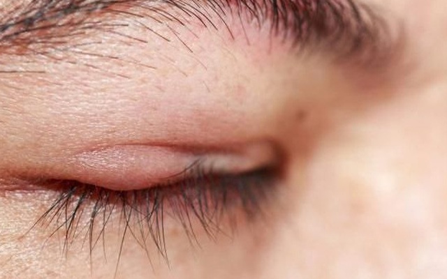 Vì sao bị viêm bờ mi?