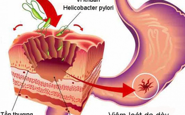 Nhiễm HP bao tử là gì?