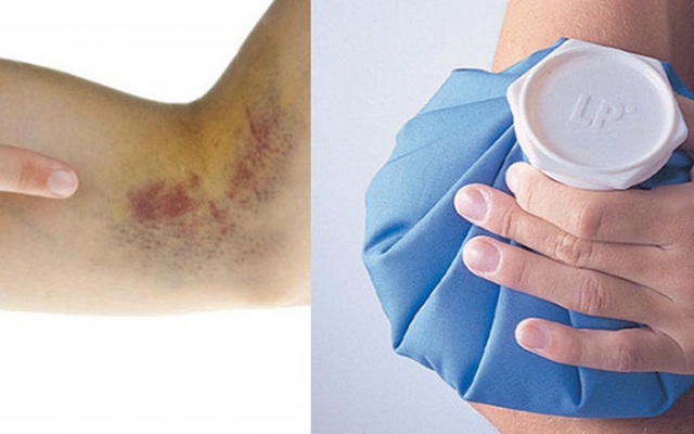 Hạn chế vết bầm trên da