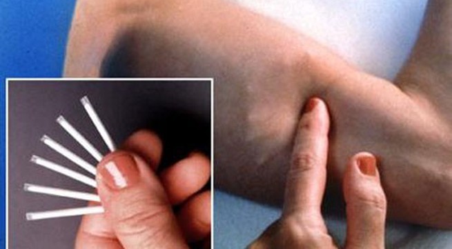 Dùng que cấy tránh thai và nỗi lo mất kinh