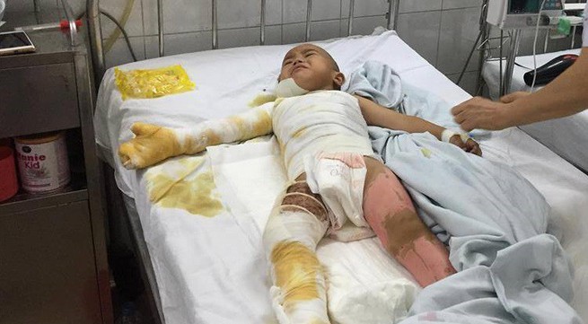 Nỗi đau tột cùng của cậu bé dân tộc bị bỏng nặng toàn thân