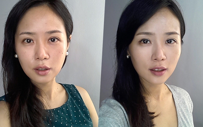 Trẻ hóa mí dưới bao lâu hồi phục?