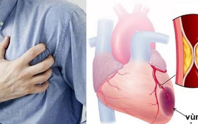 Người đ&agrave;n &ocirc;ng 47 tuổi đang khỏe mạnh bất ngờ nhồi m&aacute;u cơ tim cấp từ dấu hiệu  bất ngờ n&agrave;y