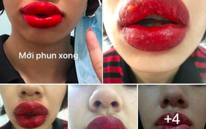Phun môi bị mụn nước có để lại sẹo không  Seoul Academy