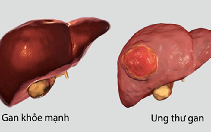 Đi khám vì mệt mỏi, đau tức ngực, người đàn ông 60 tuổi bất ngờ phát hiện ung thư gan