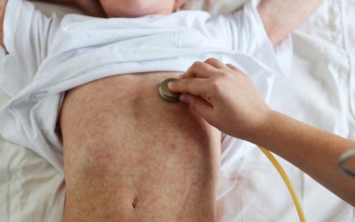 4 giai đoạn diễn biến của sởi cần biết để tránh bệnh trở nặng
