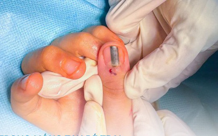 Xuất hiện vệt đen trong móng tay nghi ung thư da, bé 10 tuổi đi khám bất ngờ nhận tin vui