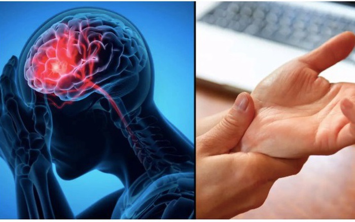 Cảnh tỉnh từ cơn đột quỵ: Bài học đau xót của người phụ nữ 58 tuổi về sức khỏe