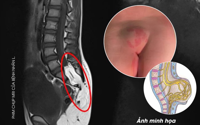 Bé 10 tuổi ở Phú Thọ bị dị tật tủy sống từ dấu hiệu nhiều người Việt bỏ qua