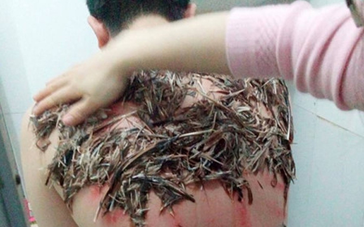 Nguy hiểm khôn lường khi dùng lông trộn tiết gà trị bệnh đậu Lào