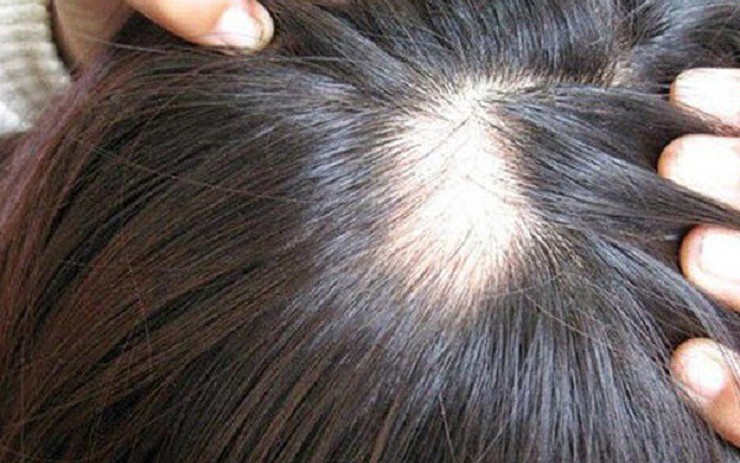 Điểm mặt 6 nguyên nhân gây rụng tóc ở đàn ông