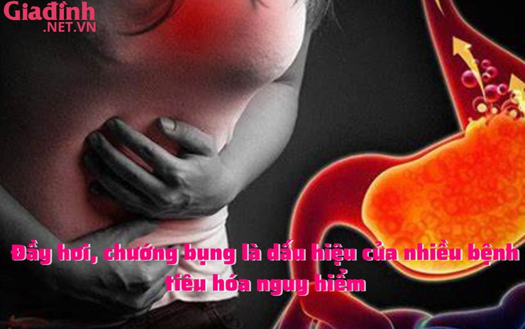 Đầy hơi, chướng bụng là dấu hiệu của nhiều bệnh tiêu hóa nguy hiểm