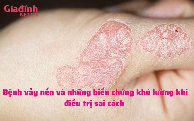 Bệnh vảy nến và những biến chứng khó lường khi điều trị sai cách 