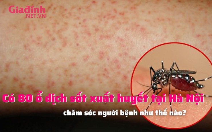 Có 80 ổ dịch sốt xuất huyết tại Hà Nội, chăm sóc người bệnh như thế nào?