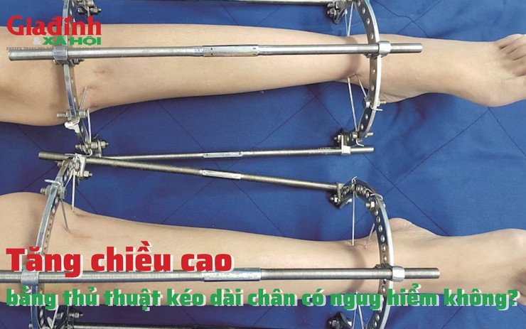 Tăng chiều cao bằng thủ thuật kéo dài chân có nguy hiểm không?