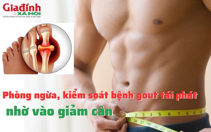 Phòng ngừa, kiểm soát bệnh gout tái phát nhờ vào giảm cân