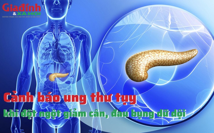 Cảnh báo ung thư tụy khi đột ngột giảm cân, đau bụng dữ dội