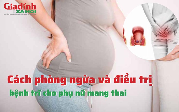 Cách phòng ngừa và điều trị bệnh trĩ cho phụ nữ mang thai