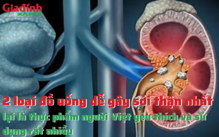 2 loại đồ uống dễ gây sỏi thận lại là thực phẩm yêu thích của nhiều người Việt 