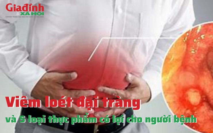 5 loại thực phẩm vô cùng có lợi cho người bị viêm loét đại tràng