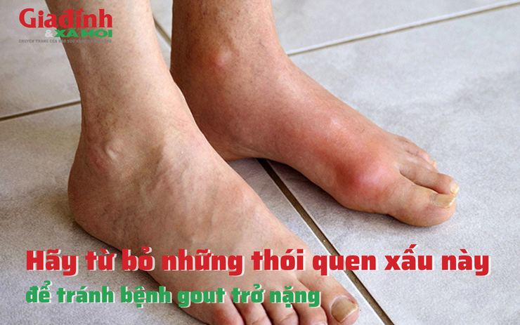 Hãy từ bỏ những thói quen xấu này để tránh bệnh gout trở nặng