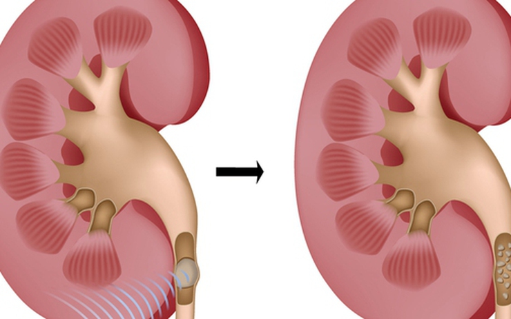 8 câu hỏi thường gặp của người bệnh sỏi tiết niệu