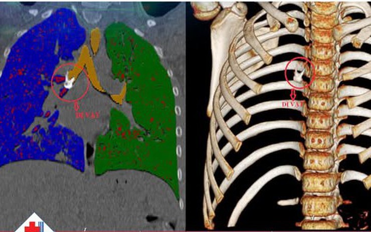Bé 8 tuổi ở Phú Thọ ho kéo dài không khỏi, đi khám bác sĩ phát hiện nguyên nhân bất ngờ