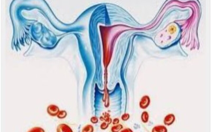 Bất ngờ 'thủ phạm' khiến người phụ nữ 40 tuổi bị rong kinh suốt 20 ngày