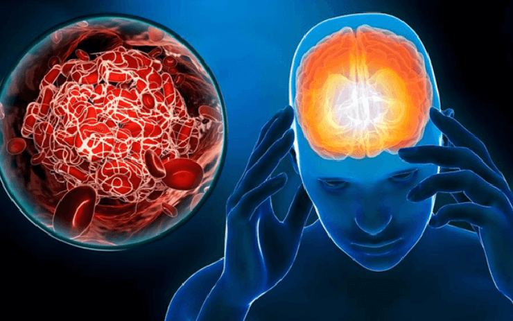 Đột quỵ não giai đoạn sớm không phải đau đầu, mà là 4 dấu hiệu này