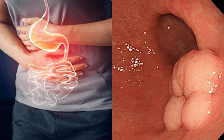 Chỉ nghĩ bị viêm đường tiêu hóa, nam sinh 17 tuổi đi khám phát hiện ung thư dạ dày: Có dấu hiệu này không nên chủ quan