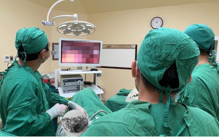 Đau bụng kéo dài, người phụ nữ 63 tuổi đi khám phát hiện dị vật quen thuộc trong bữa cơm