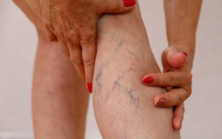 5 điều bác sĩ mạch máu nhắn nhủ bệnh nhân suy giãn tĩnh mạch ăn Tết vui khỏe, hạn chế gặp nhau trong bệnh viện