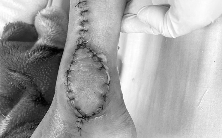 Bé 8 tuổi ở Hà Nội phát hiện mắc ung thư sụn từ dấu hiệu đau chân bất thường