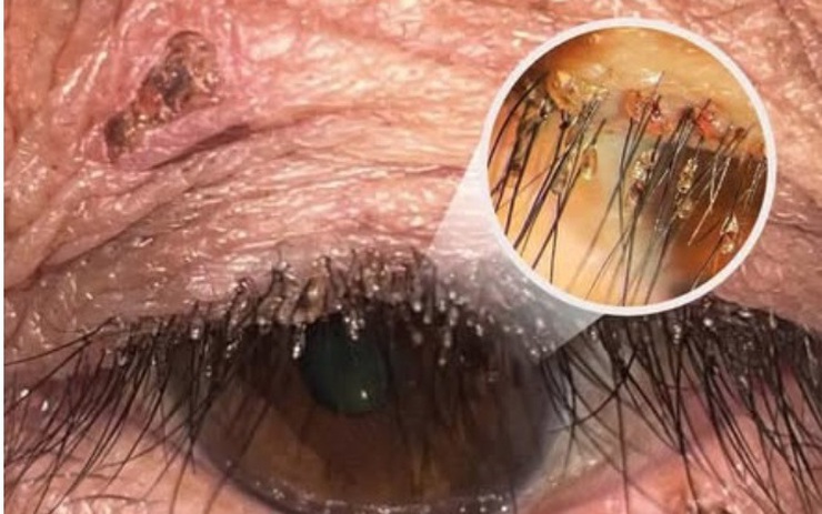 Đi khám vì cộm và ngứa mắt, bất ngờ phát hiện rận mu bám chi chít trên lông mi