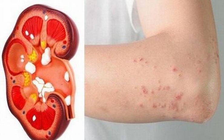 Bất ngờ phát hiện suy thận giai đoạn nặng từ dấu hiệu nhiều người Việt mắc phải nhưng dễ bỏ qua
